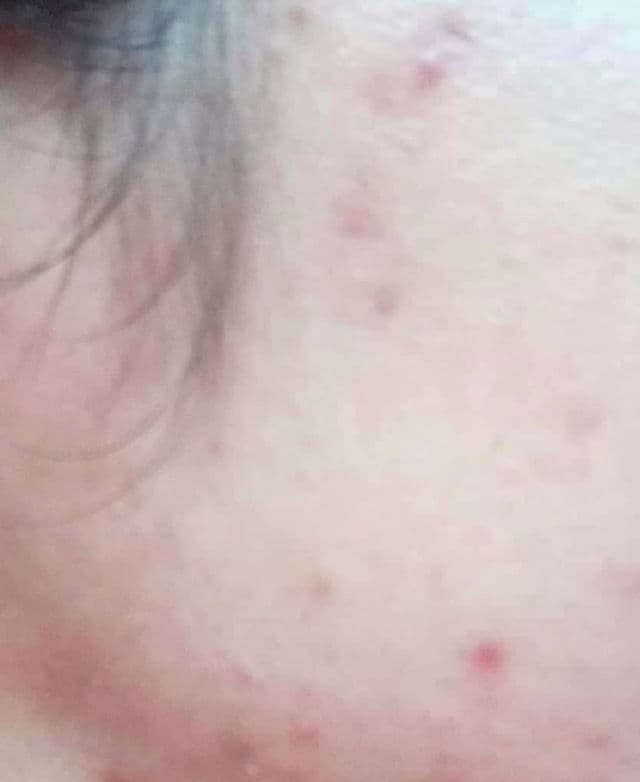 Oxecure Acne Clear Powder Mud review photo by PickyAddict