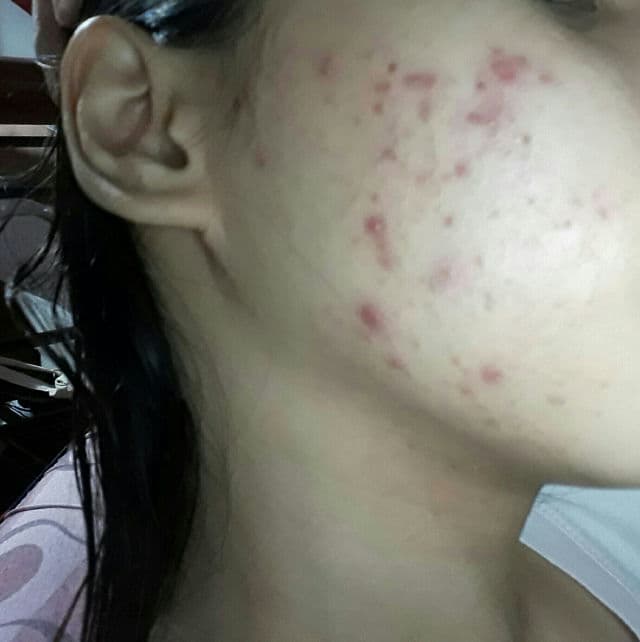 Dermorepubliq 10% Niacinamide + Hyaluronic Acid Face Anti-Blemish Serum review photo by PickyGie