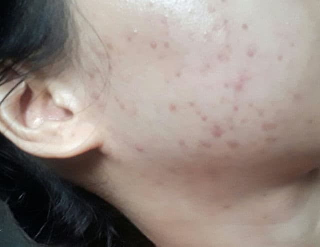 Dermorepubliq 10% Niacinamide + Hyaluronic Acid Face Anti-Blemish Serum review photo by PickyGie