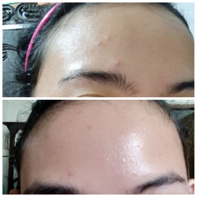 Dermaluz Acne Spot Treatment review photo by Resma