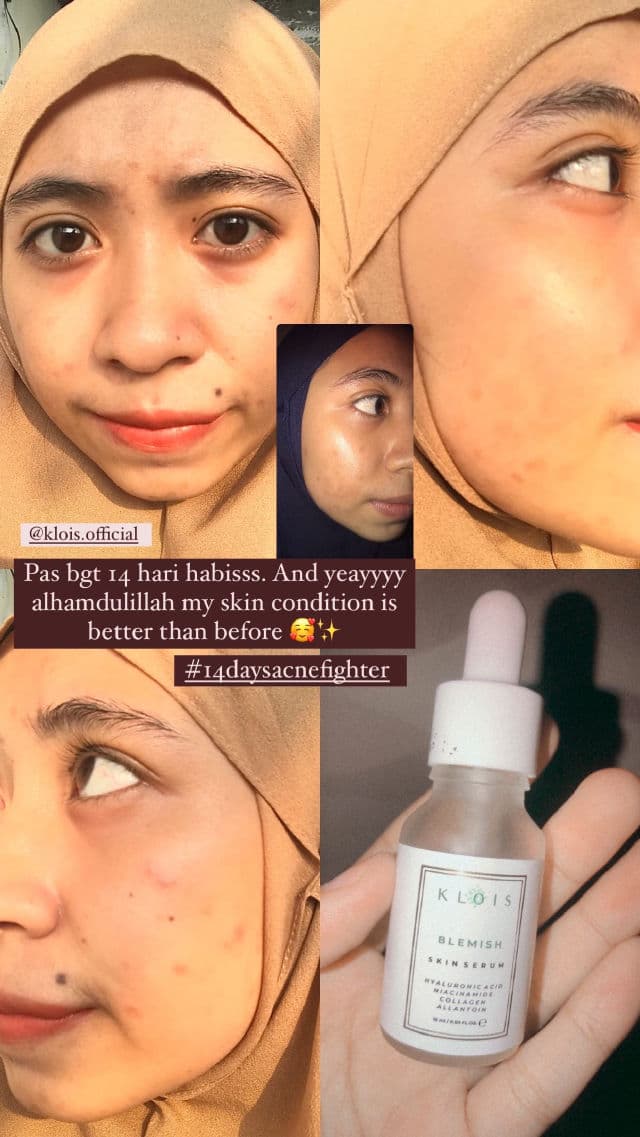 KLOIS Blemish Skin Serum review photo by SHMILY