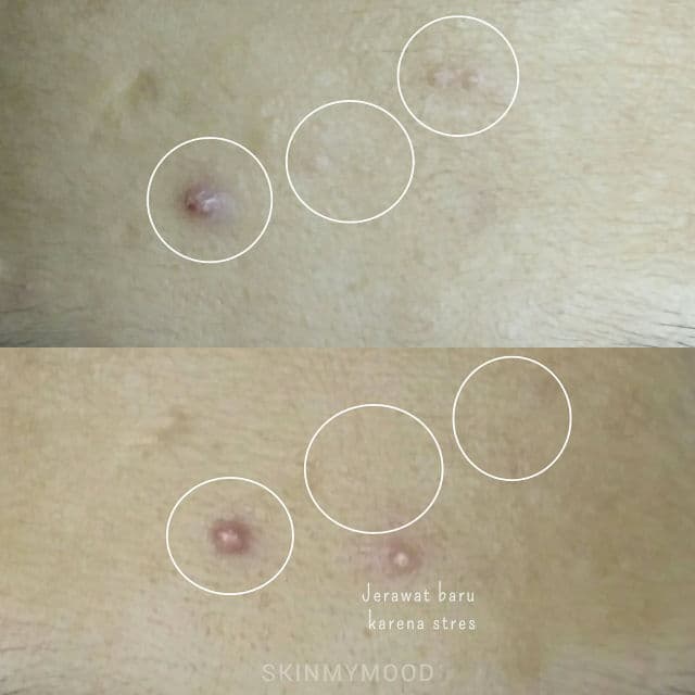 aknema BHA + HA Serum review photo by Skinmymood