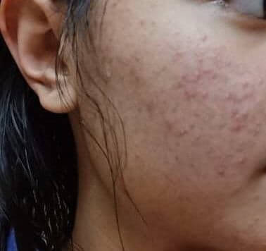 Stridex Daily Care Acne Pads with Salicylic Acid, Maximum Strength review photo by Sydney