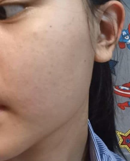 Stridex Daily Care Acne Pads with Salicylic Acid, Maximum Strength review photo by Sydney