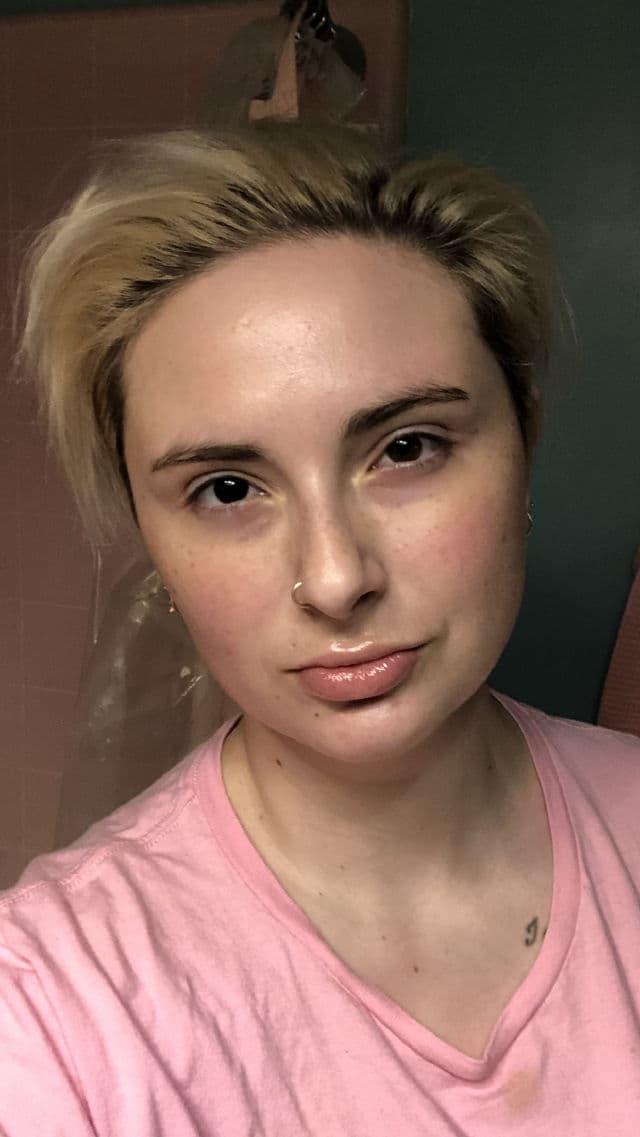 Johnson's Tretinoin Retino-A 0.025% Cream review photo by ThisEerieSkin