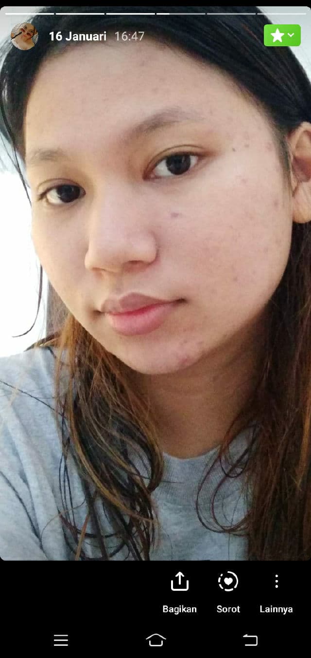 Acnoc Acneser Spot Gel review photo by Uyoungbae