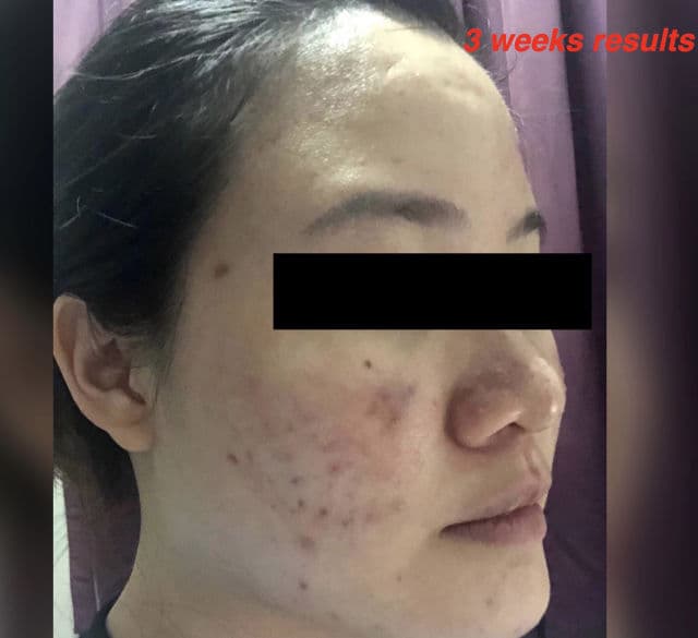 Dr. Wu Intensive Renewal Serum With Mandelic Acid 18% review photo by Winkie