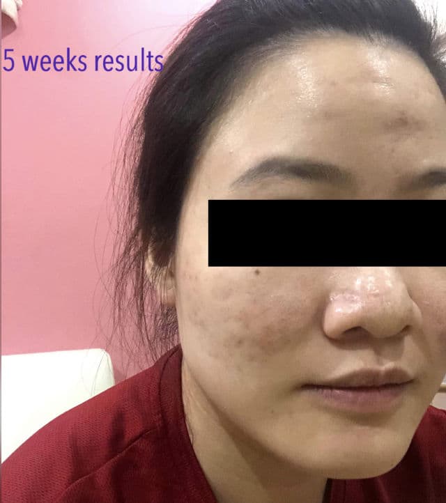 Dr. Wu Intensive Renewal Serum With Mandelic Acid 18% review photo by Winkie