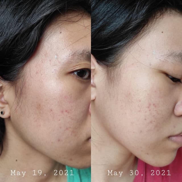 Lanbena TCM Scar and Acne Mark Removal Gel Ointment review photo by Zenister