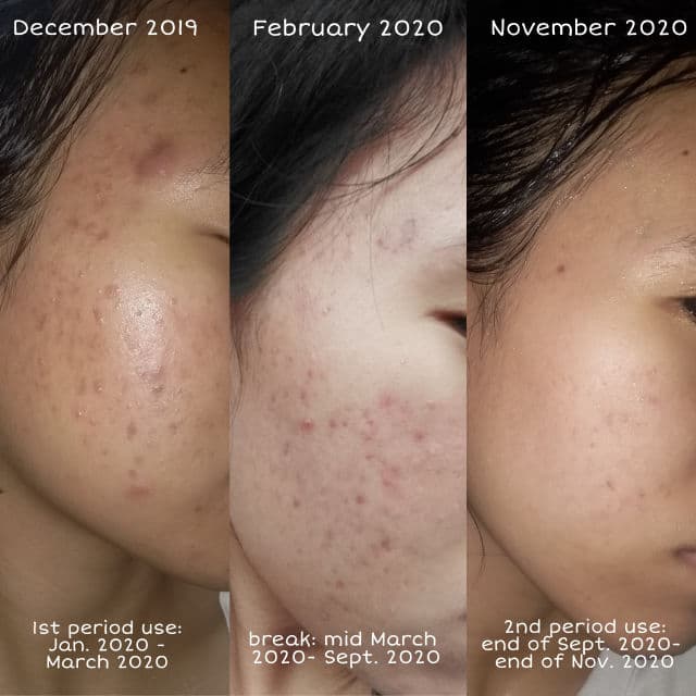 Maxi-Peel Exfoliant Solution review photo by Zenister