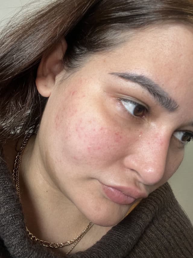 TIRTIR Azelaic Acid 12% Serum review photo by genesisrammy