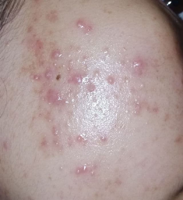 COSRX AHA/BHA Clarifying Treatment Toner review photo by Sitiaidahussin