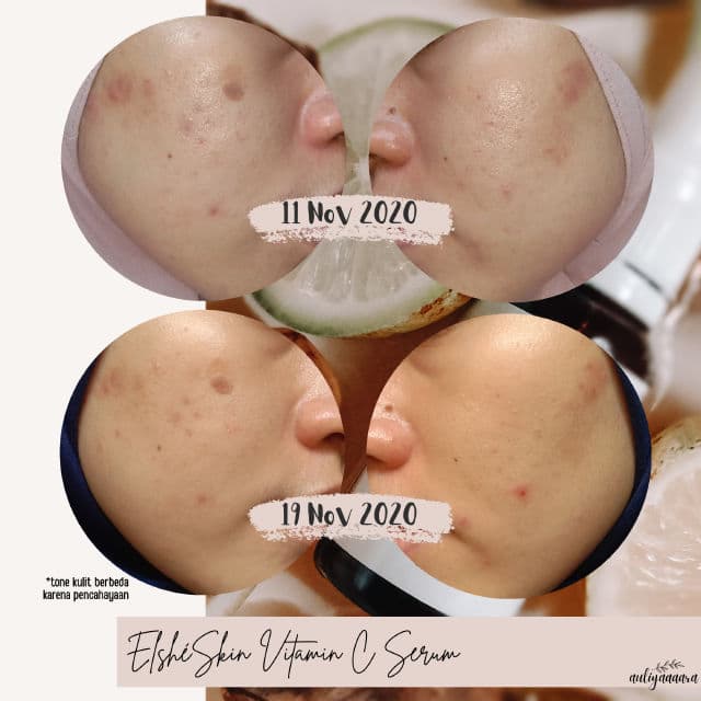ElsheSkin Vitamin C Serum review photo by auliyaaaara