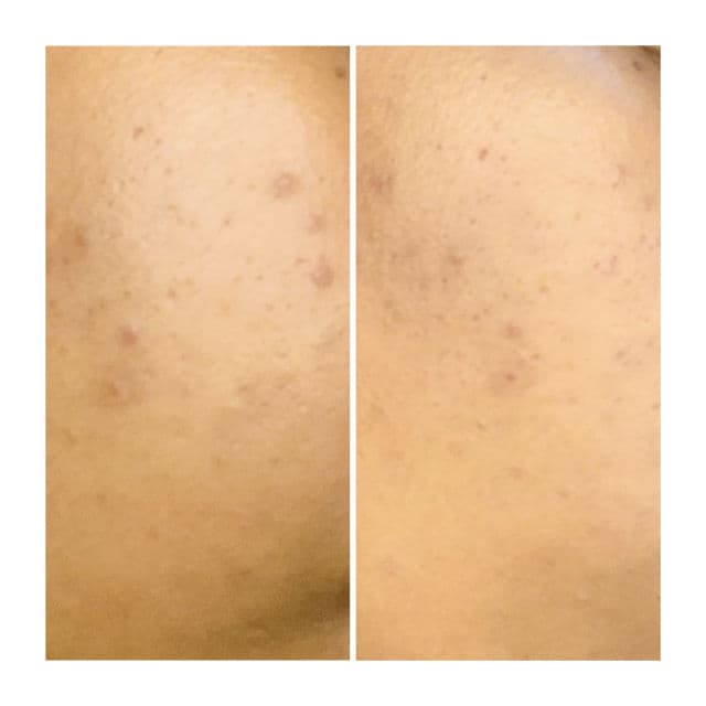 Minimalist Alpha Arbutin 2% + Hyaluronic Acid 1% review photo by blogbabee