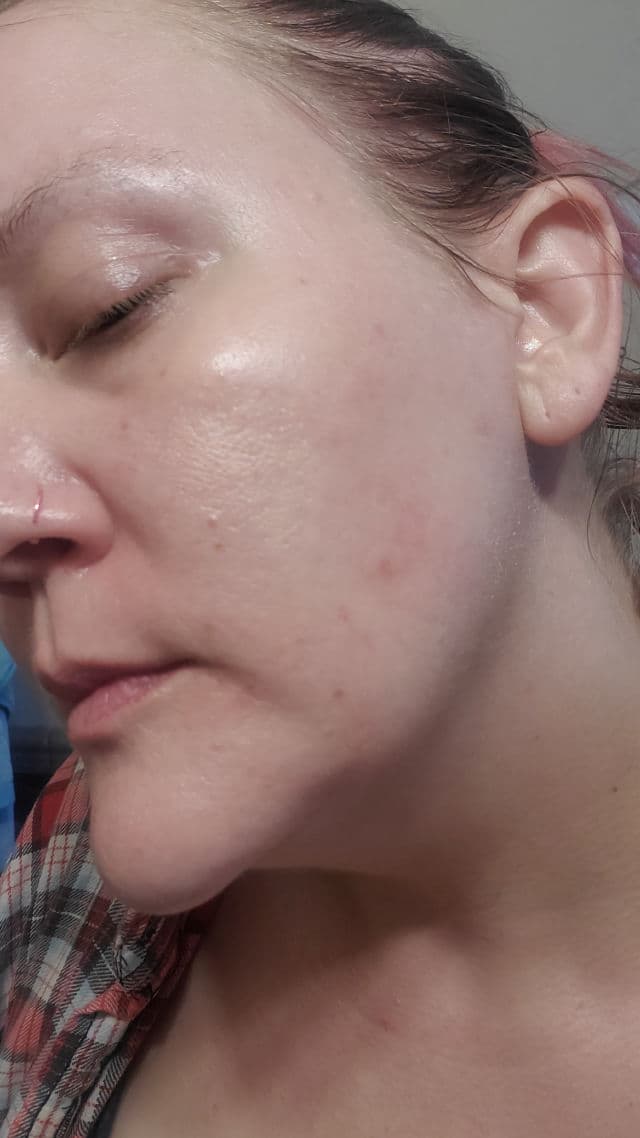 Hero Cosmetics Mighty Patch Invisible+ review photo by beautybonnebeth