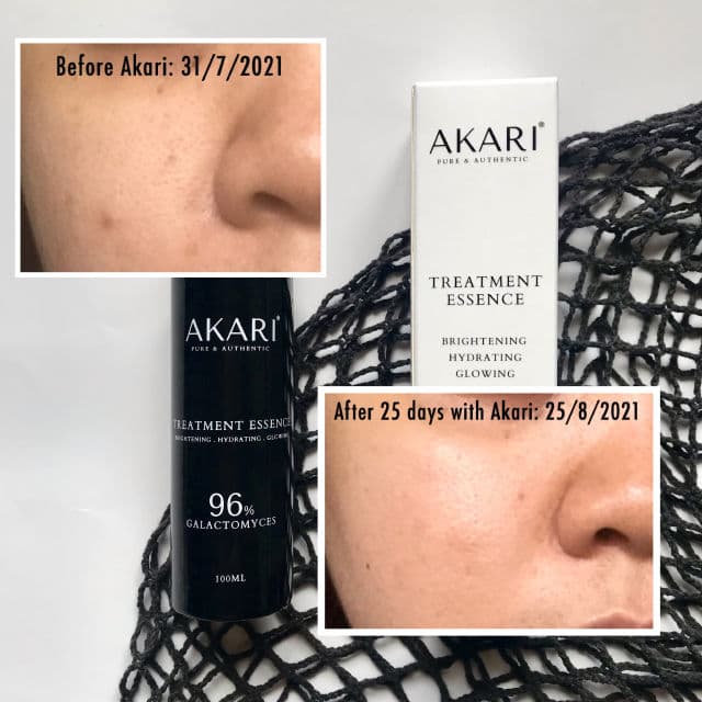 AKARI Treatment Essence review photo by caramelskindiary