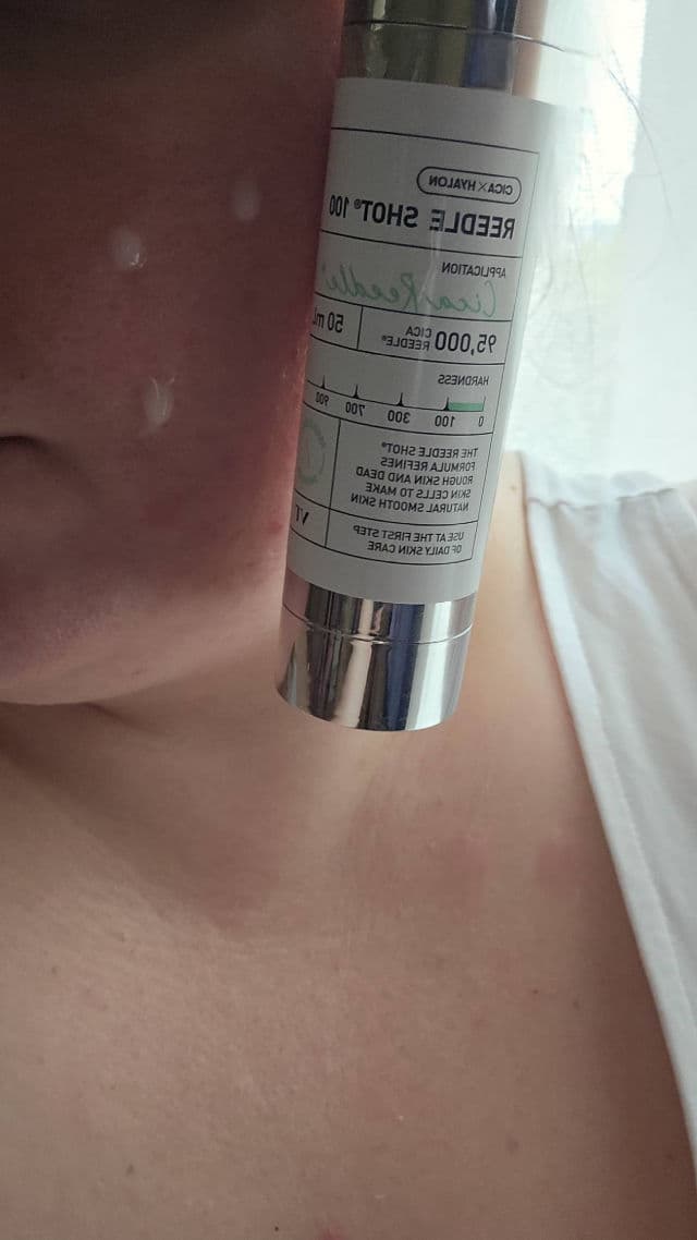 VT COSMETICS Reedle Shot 100 review photo by vanillabloom