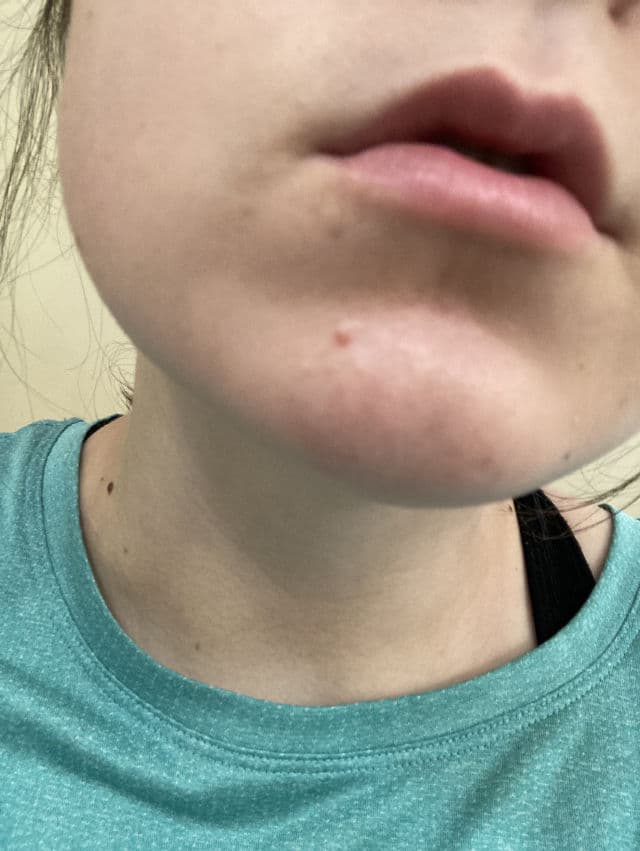 Thursday Plantation Tea Tree Oil review photo by curlyemily