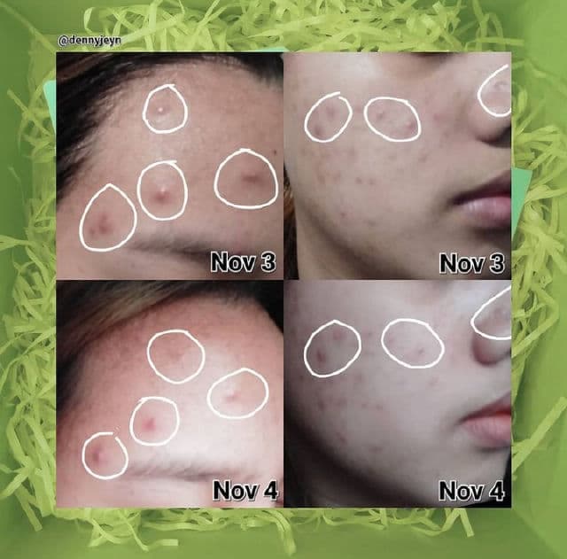 A.Stop Spot Treatment & Care Patch review photo by dennyjeyn