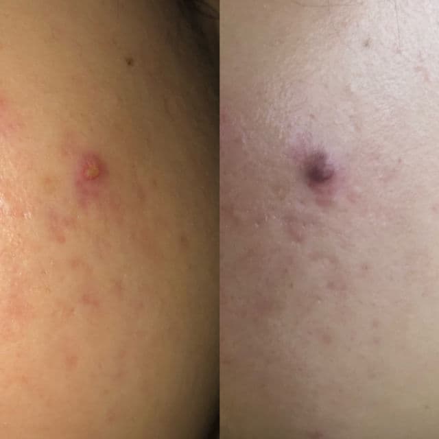 Acnoc Acneser Spot Gel review photo by ditaputri