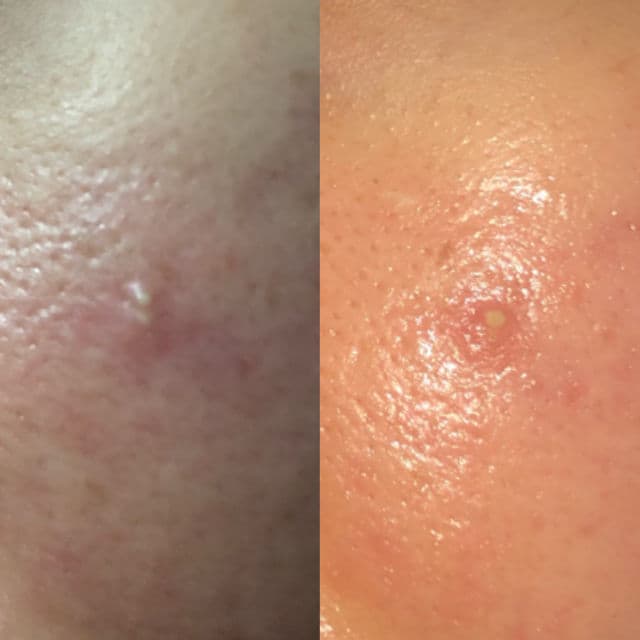 Acnoc Acneser Spot Gel review photo by ditaputri