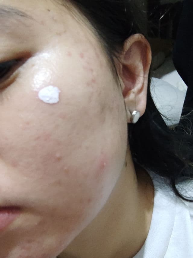 NEOGEN Dermalogy A-Clear Aid Soothing Pink Eraser review photo by elocinism