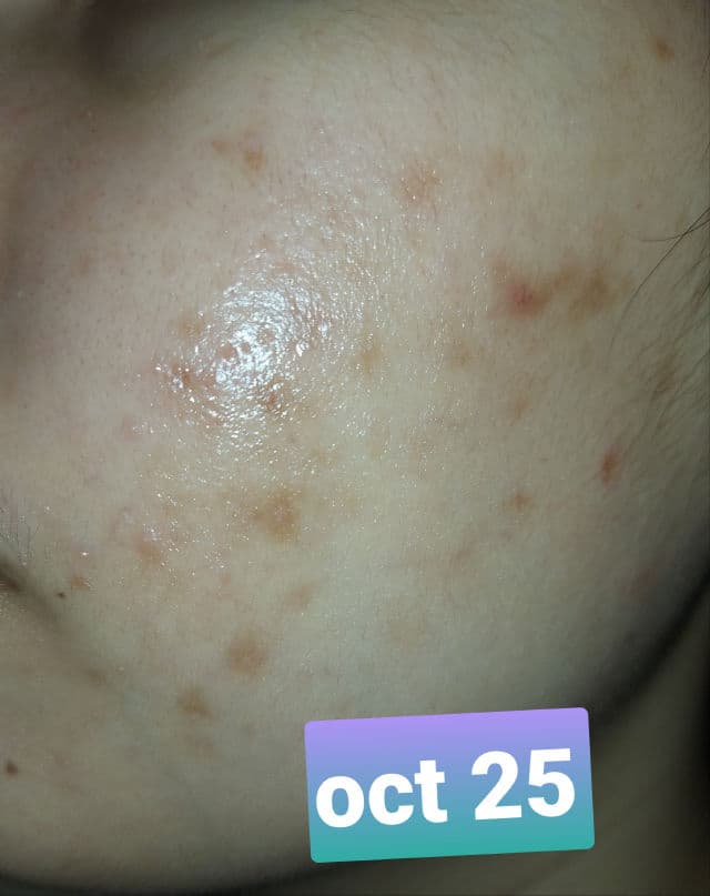 Maxi-Peel Exfoliant Solution review photo by zom