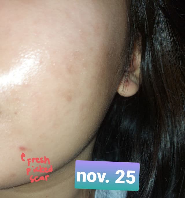 Maxi-Peel Exfoliant Solution review photo by zom