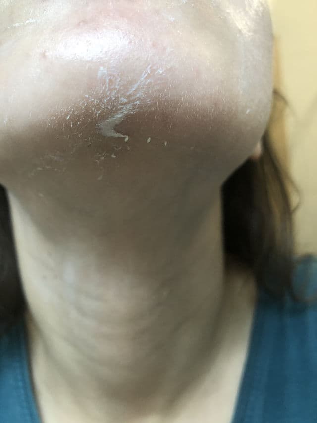 La Roche-Posay Anthelios Anti-Imperfections Gel-Cream SPF50+ review photo by fani98