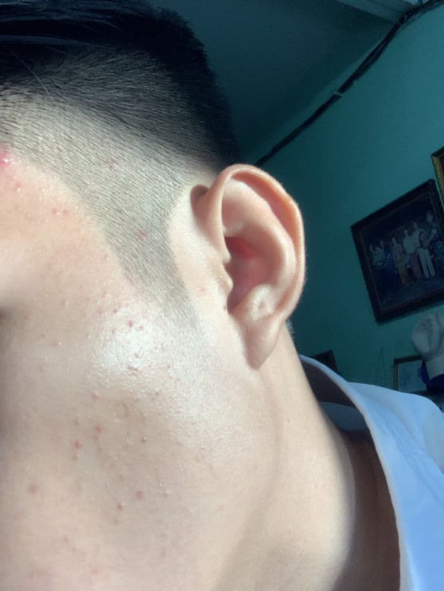 T3 Acne Facial Foam review photo by hongy