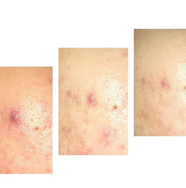 Dear Me Beauty Retinol + Blueberry Extract Face Serum review photo by inasbilabila