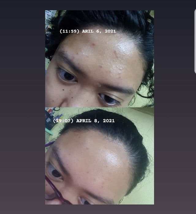 Lanbena TCM Scar and Acne Mark Removal Gel Ointment review photo by izmelexxie