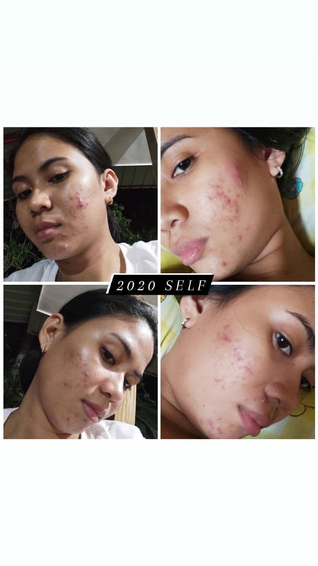 Breylee Acne Scar Removal Cream review photo by jasmincmagbanua