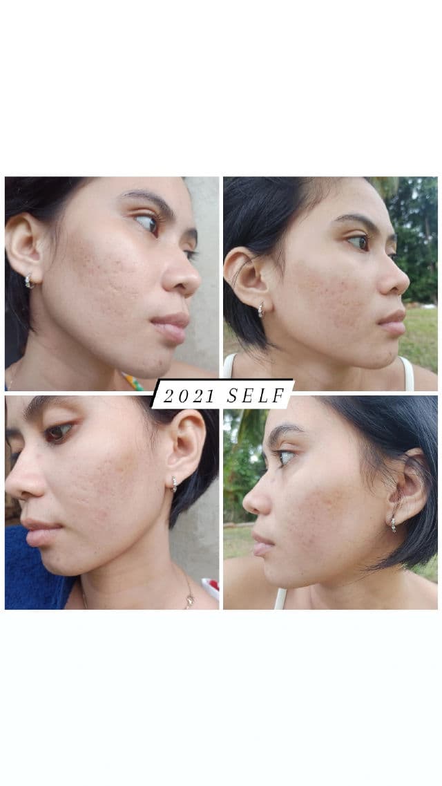Breylee Acne Scar Removal Cream review photo by jasmincmagbanua