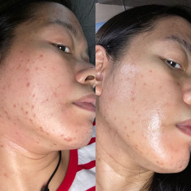 ZO Skin Health Oil Control Pads Acne Treatment review photo by jenabrencillo