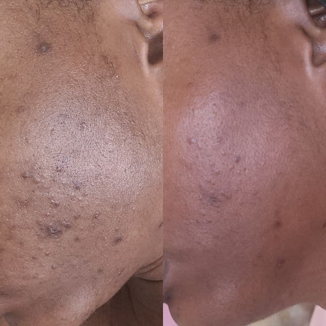 Obagi Professional-C Serum 20% review photo by jodibalfour