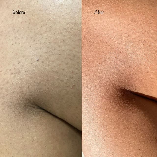 CeraVe SA Lotion for Rough & Bumpy Skin review photo by keerthi