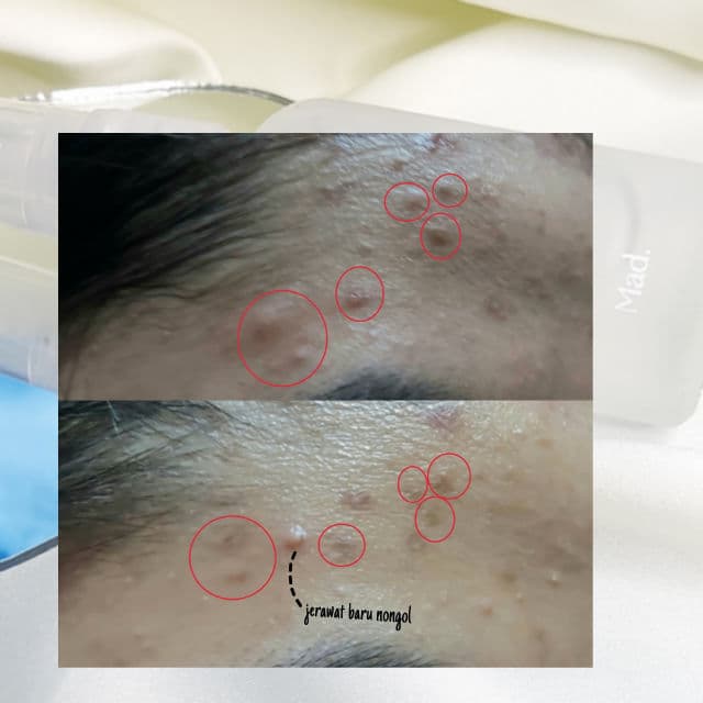 Mad For Makeup Calm PIH/PIE Serum Gel Moisturizer review photo by lilactosky