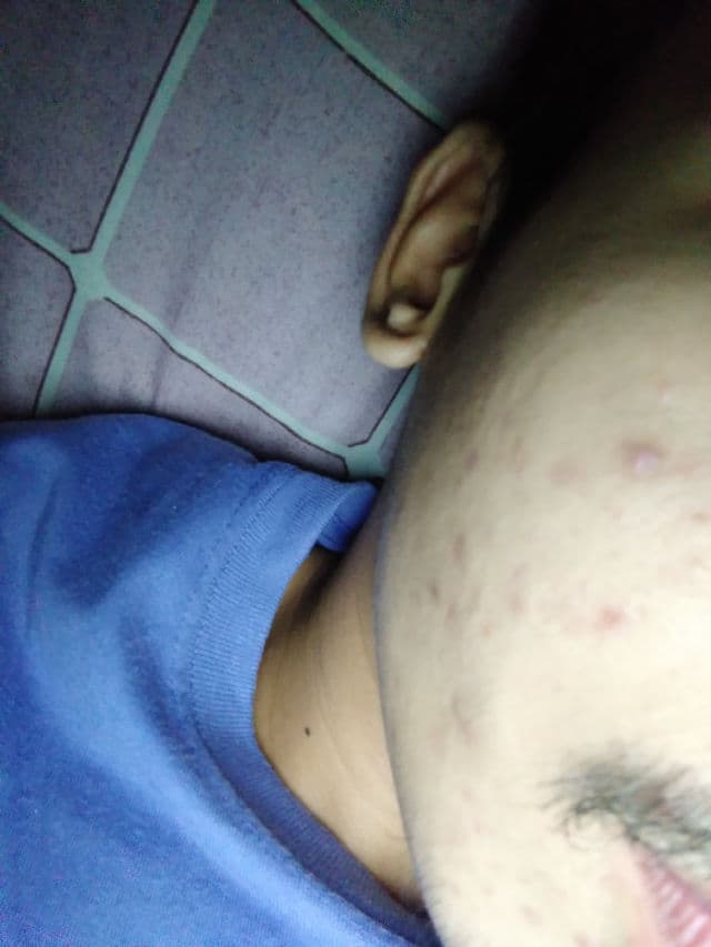 AcneCare Acne Care Drying Lotion review photo by markep