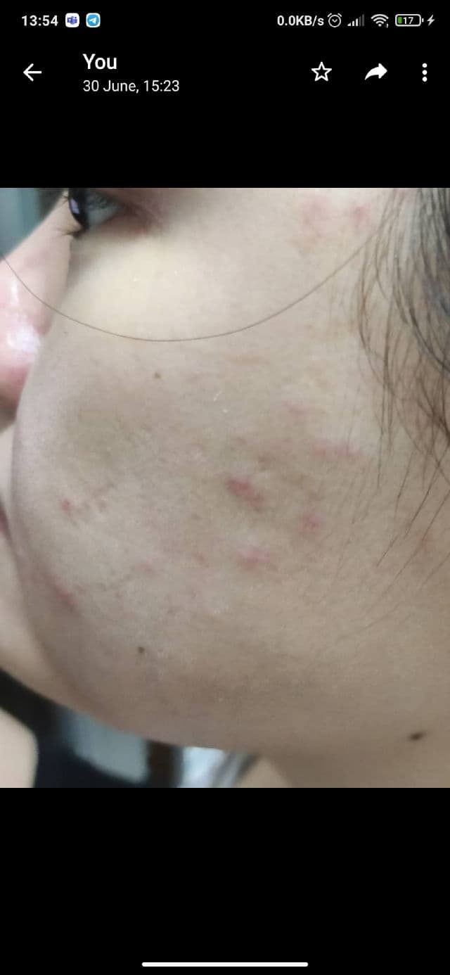 Derm10 Mediclear Comedone Complex review photo by maypiing