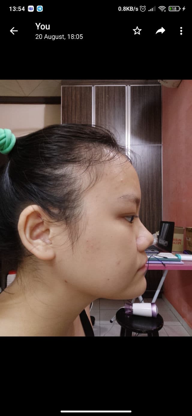 Derm10 Mediclear Comedone Complex review photo by maypiing