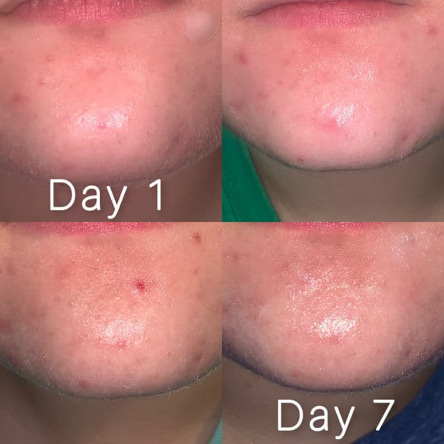 Lopsx Acne Treatment Cream review photo by mmskin