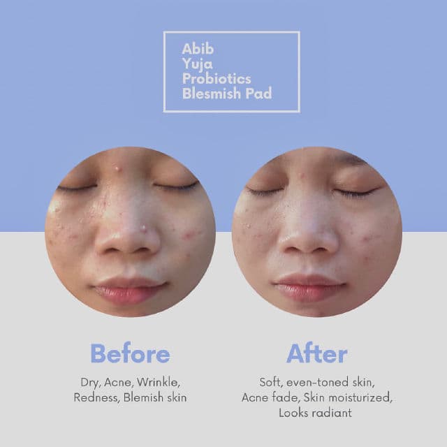 Abib Yuja Probiotics Blemish Pad Vitalizing Touch review photo by poetrydiane