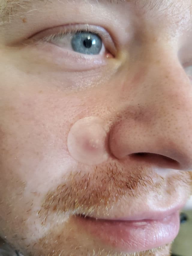 Hero Cosmetics Mighty Patch Micropoint for Blemishes review photo by dewydweeb