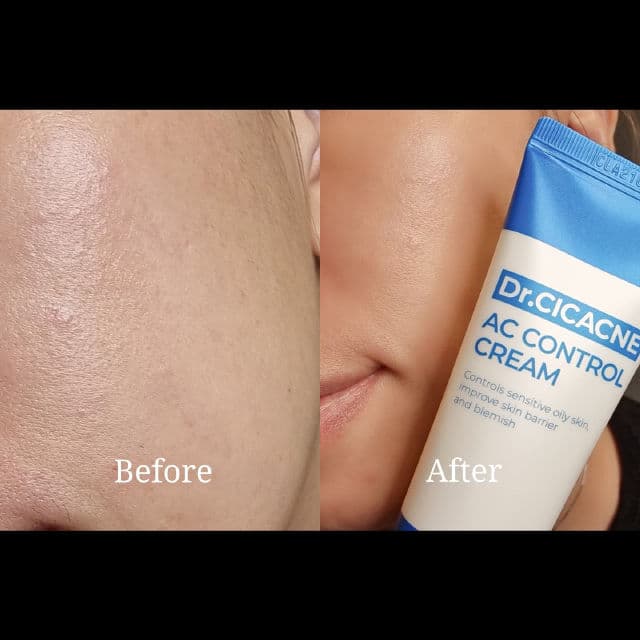 Dr.CICACNE AC Control Cream review photo by rebeccaxseah