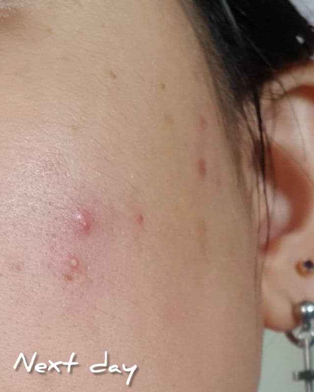 Gratitude Bar Acne Clear Drops review photo by rheadoo