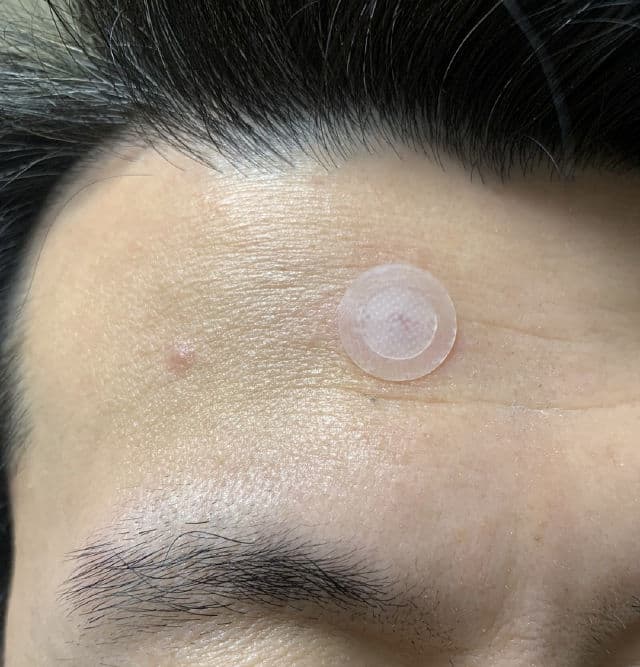 NolaHour Microneedle Pimple Patch for Early-stage Acne review photo by rojin