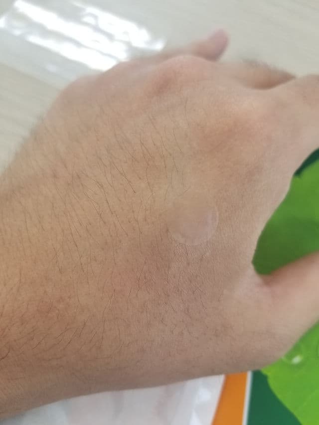 NolaHour Hydrocolloid Clear Soothing Pimple Patch for Acne Recovery Stage review photo by rojin