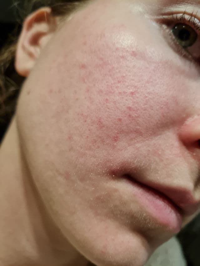 Soolantra 10 Mg/G Cream review photo by sensitivejean