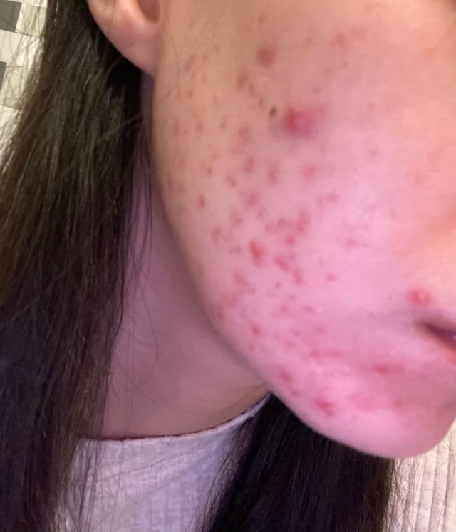 Kate Somerville EradiKate Acne Treatment review photo by sevd